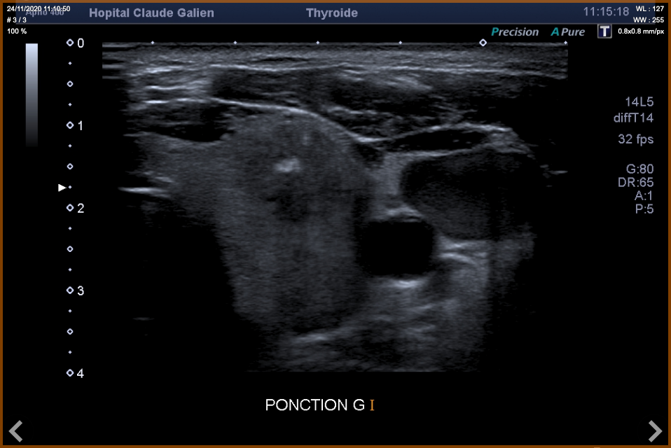 Cytoponction thyroidienne