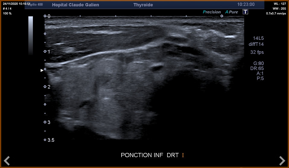 Cytoponction thyroidienne