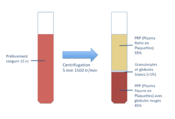 Injection de plasma riche en plaquettes (PRP)