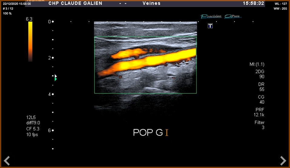 Echographie et Doppler