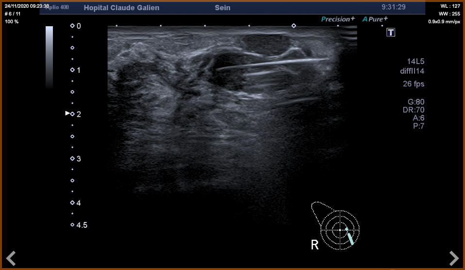 Echographie mammaire